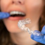 Invisalign in San Antonio: A Modern Approach to Orthodontic Treatment_FI
