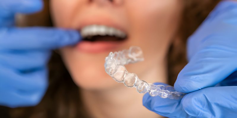 Invisalign in San Antonio: A Modern Approach to Orthodontic Treatment_FI