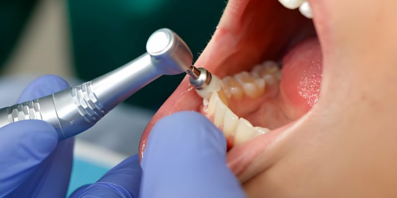 Understanding Dental Cleanings: How Long Should They Take_FI