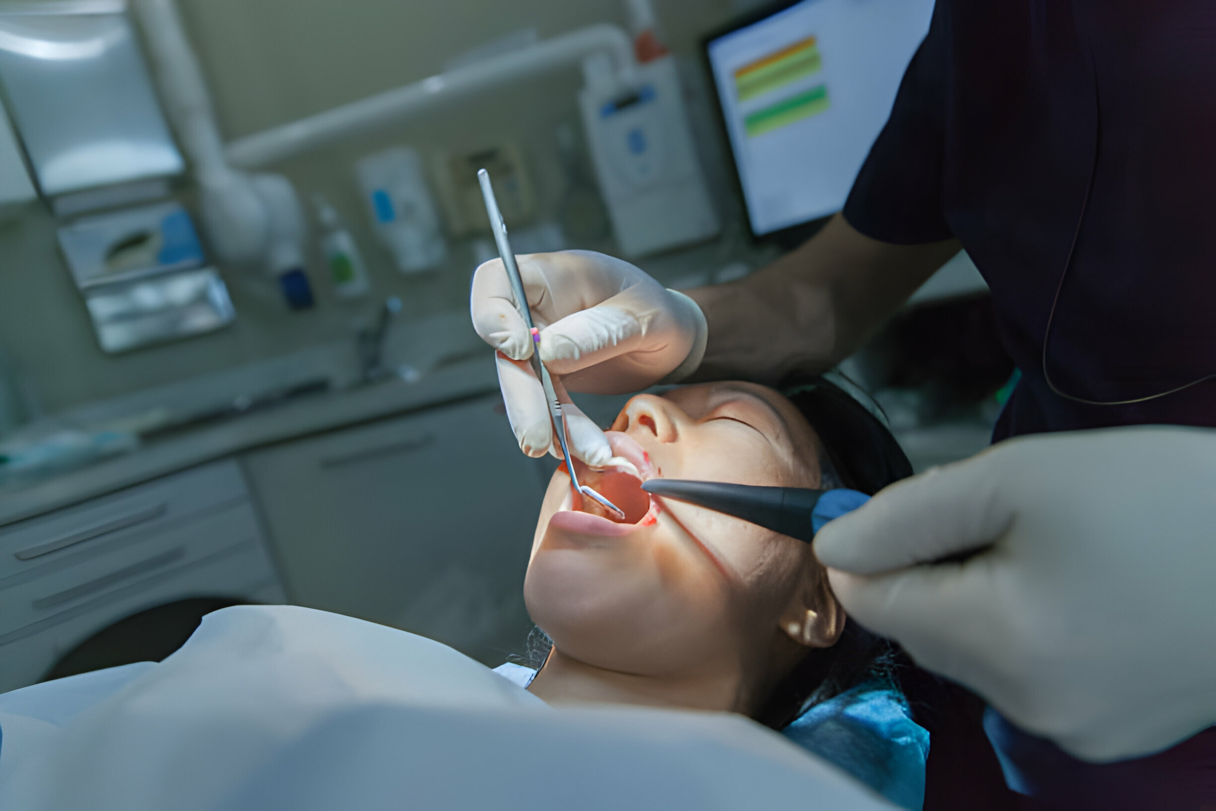 Tooth Extraction In San Antonio: A Comprehensive Guide_2