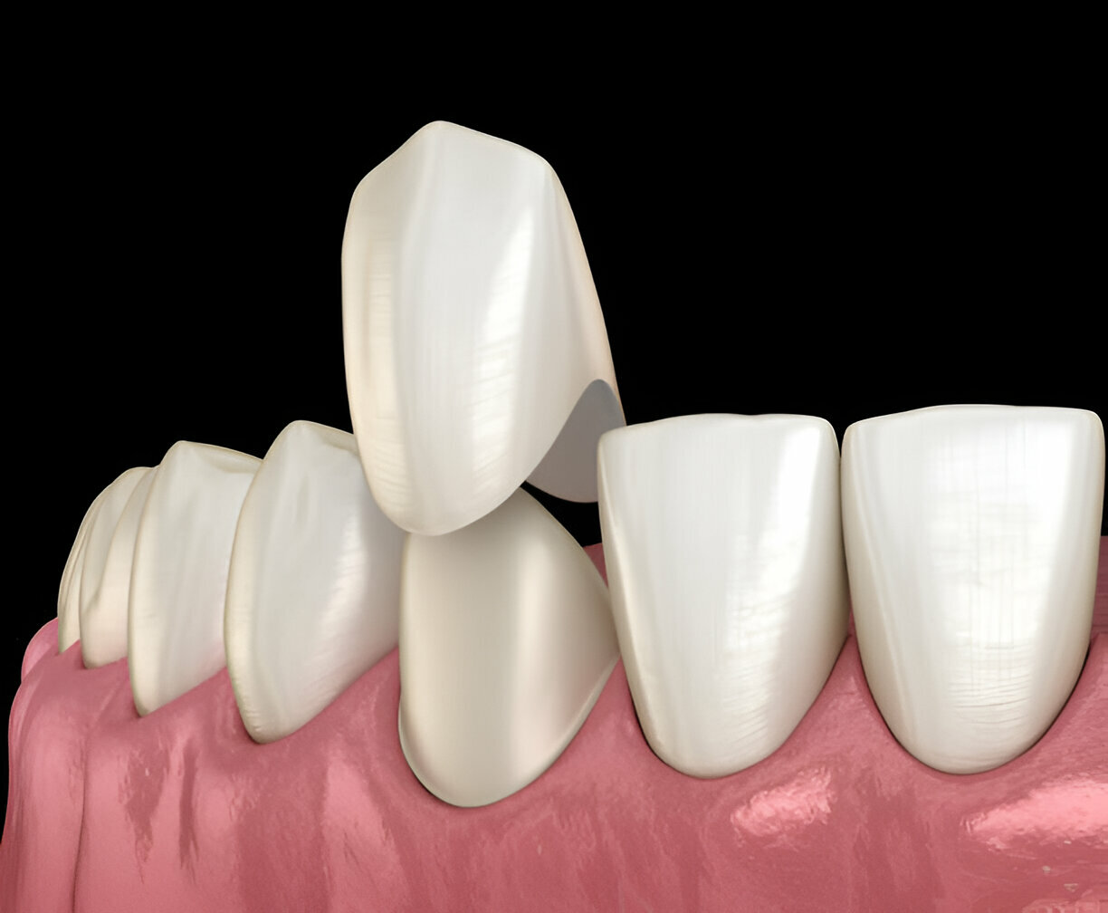 Choosing the Right Dental Crown: A Complete Guide by Heritage Dental in San Antonio, TX_2