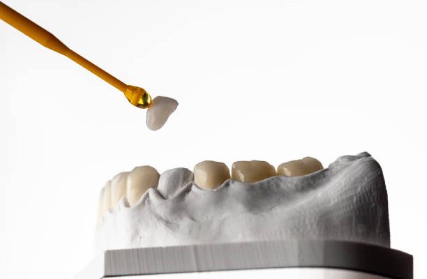 Same-Day Dental Crowns in San Antonio TX Heritage Dental’s CEREC Technology