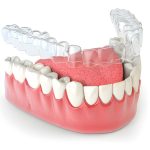 Straighten Your Smile with Invisalign at Heritage Dental in San Antonio_FI