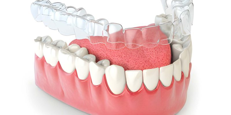 Straighten Your Smile with Invisalign at Heritage Dental in San Antonio_FI