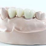 How Dental Bridges Work - San Antonio Dentist Explains Your Options_FI