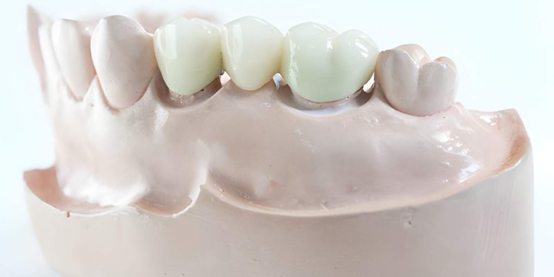 How Dental Bridges Work - San Antonio Dentist Explains Your Options_FI