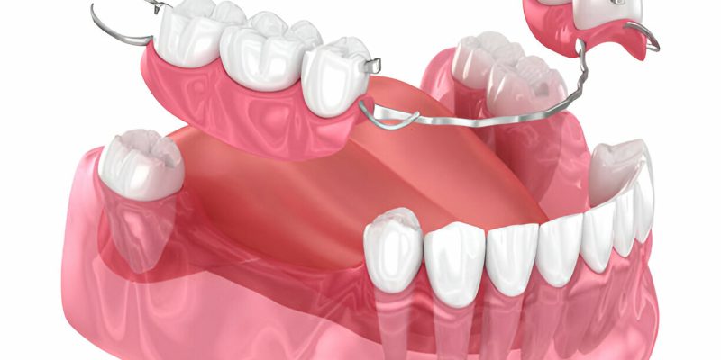 Full vs. Partial Dentures: Which Option Is Right for You? San Antonio Dentist Explains_FI