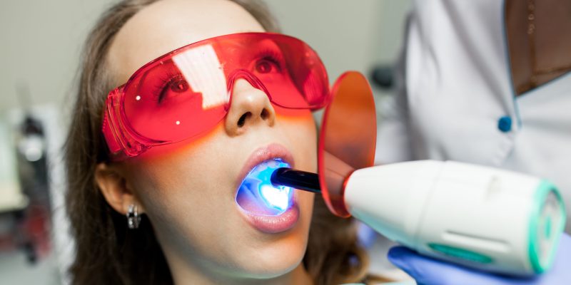 Before and after professional teeth whitening treatment by a dentist in San Antonio TX